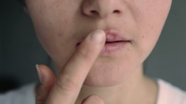 Uçuktan etkilenmiş dudaklı genç bir kadın. İyileşme merhemi sürüyorum. Kız dudaklarına uçuktan etkilenmiş bir parmağıyla dokunuyor ve şifalı bir merhem sürüyor. Güzellik dermatolojisi kavramı.