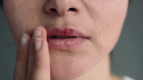 唇部被疱疹感染的年轻女人的面部部分 这个女孩用手指触摸着受疱疹影响的嘴唇 痛死了美容皮肤科概念 — 图库视频影像
