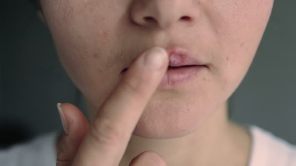 Wanita Muda Dengan Bibir Dipengaruhi Oleh Herpes Menerapkan Obat Penyembuh — Stok Video
