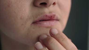 Uçuktan etkilenmiş dudakları olan genç bir kadının yüzü. Parmağı uçuktan etkilenen dudaklara dokunan kız. Acıyor. Güzellik dermatolojisi konsepti.