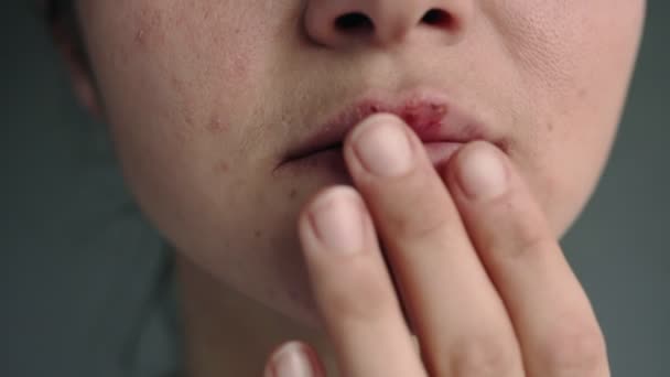 Bagian Dari Wajah Seorang Wanita Muda Dengan Bibir Dipengaruhi Oleh — Stok Video