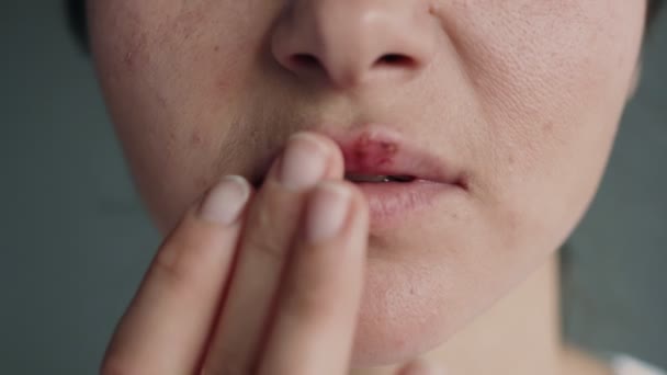 Μέρος Του Προσώπου Μιας Νεαρής Γυναίκας Χείλη Που Έχουν Προσβληθεί — Αρχείο Βίντεο