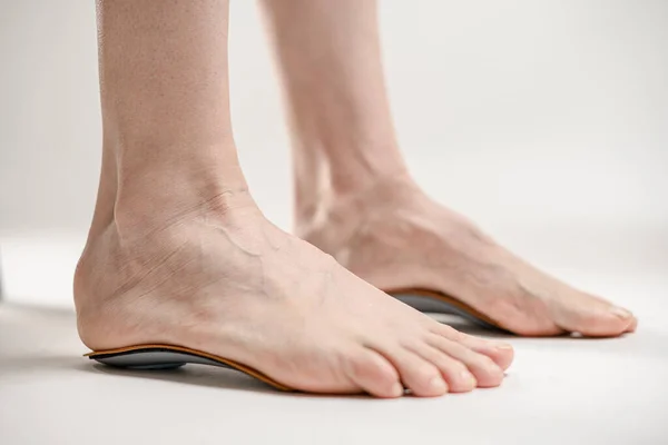 Barefoot Female Legs Flatfeet Problem —  Fotos de Stock
