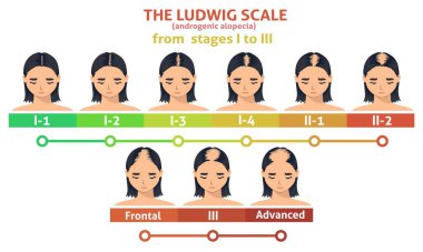 Ludwig ölçeğinde androjenik alopecia. Kadın kelleşen ilerleme posteri. Saç dökülme problemi bilgileri. Üç aşamada saç dökülmesi belirtileri gösteren bir kadın.