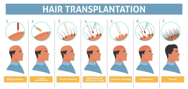 男性の髪の移植ステップベクトルポスター インプラントイラストで太った男の治療 脱毛症は インフォグラフィックを治す メソセラピーと濾胞性ユニット抽出手順 — ストックベクタ