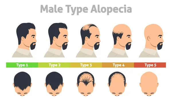 男性型脱毛症のポスター 脱毛ステージベクトル 男性の頭皮と男性の遺伝的バランスの進捗状況 航空会社の間伐プロセスのイラスト — ストックベクタ