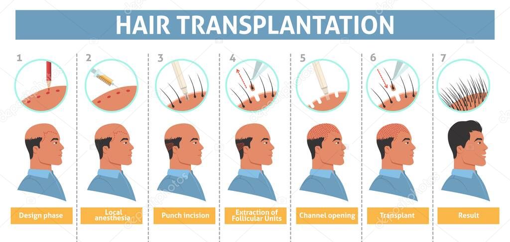 Male person hair transplantation step vector poster. Bald man treatment with implant illustration. Alopecia disease cure infographic. Mesotherapy and follicular unit extraction procedure