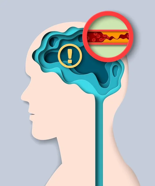 Brain Stroke Medical Vector Paper Cut Illustration Human Head Vessel — Stock Vector