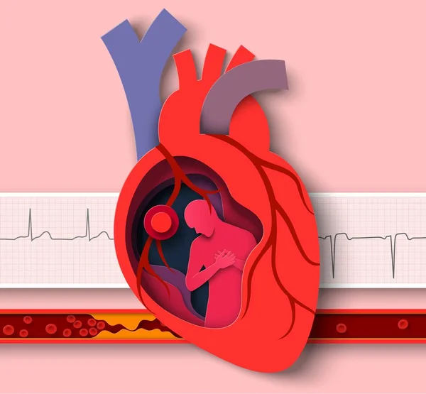 Vettore Taglio Carta Infarto Poster Medico Malattie Cardiologiche Anatomia Dell — Vettoriale Stock