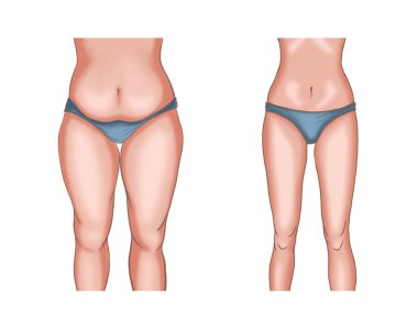 Kilo kaybı veya liposuction öncesi ve sonrası vücudun çizimi
