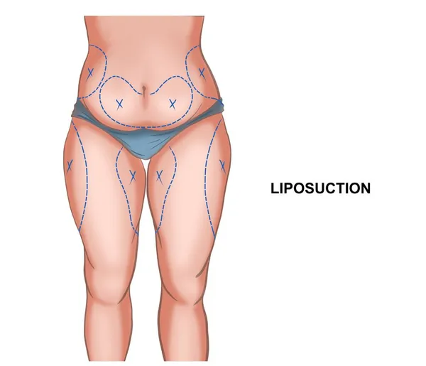 Illustrazione Dei Segni Sul Corpo Liposuzione — Foto Stock