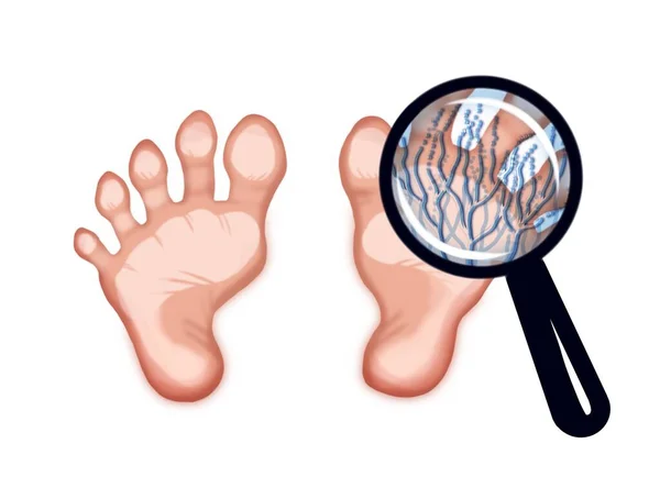 Illustration Foot Affected Fungus — Stock Photo, Image