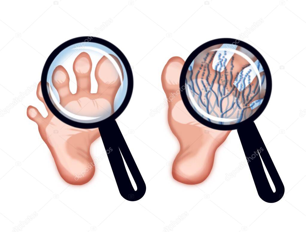 illustration of a foot affected by a fungus