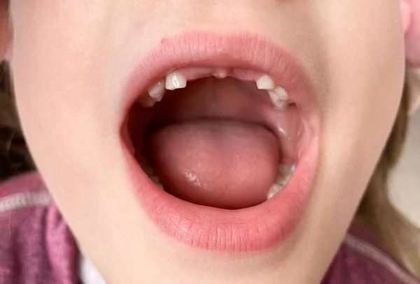 Випало Верхнє Пір Молочних Зубів — стокове фото