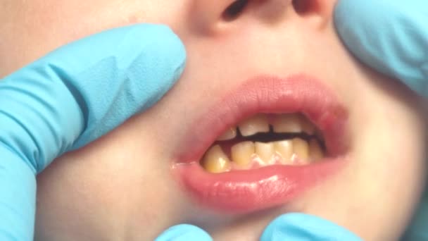 Las manos de los médicos en guantes azules muestran daño en el labio y las encías en los dientes delanteros del bebé. — Vídeo de stock