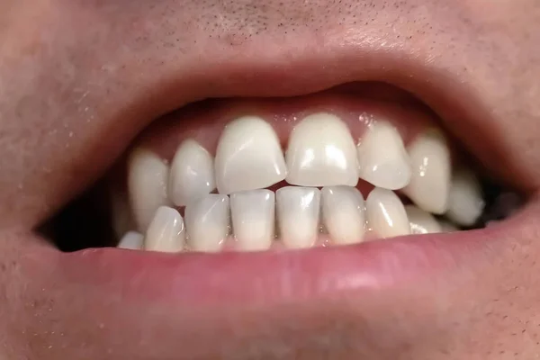 Los Dientes Acercan Hombre Muestra Sus Dientes Una Cita Con —  Fotos de Stock