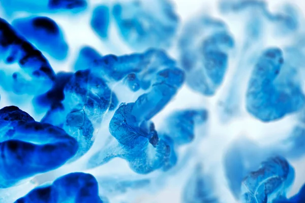 Células Tumorais Microscópio Tecidos Afetados Por Células Cancerígenas Microscópio Nauka — Fotografia de Stock