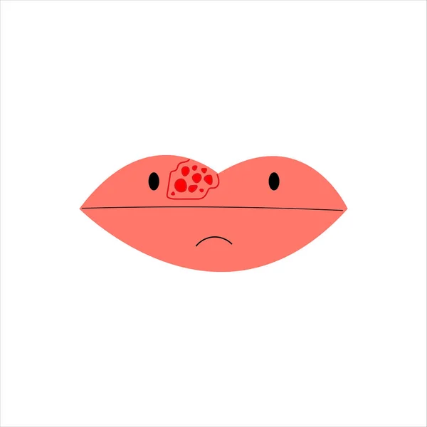 Lips Closeup Cold Herpes Sore Lip Vector — Stock Vector