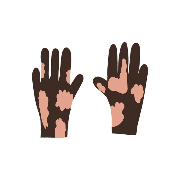Desenho Animado Vetorial Plana Ilustração Mãos Com Vitiligo Dia Mundial —  Vetores de Stock