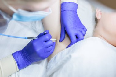 doctor electrolysis removes unwanted hairs from the armpit area using electricity
