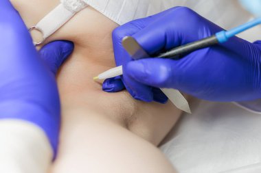 macro photography of the electrolysis procedure for removing unwanted hair with the help of electricity using a tweezer electrode held by the master