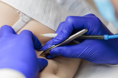 macro photography of the electrolysis procedure for removing unwanted hair with the help of electricity using a tweezer electrode held by the master