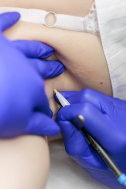 macro photography cosmetic procedures for removing unwanted hairs using electrolysis