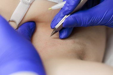 macro photography cosmetic procedures for removing unwanted hairs using electrolysis