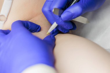 macro photography cosmetic procedures for removing unwanted hairs using electrolysis