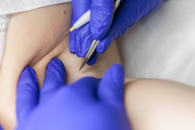 close-up in the doctor's hands medical tweezers and an electrode for hair removal using electrolysis in the armpit area