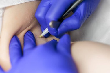 in the doctor's cosmetology office removes unwanted hairs with the help of electrolysis in the armpit area