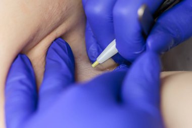 close-up in the doctor's hands medical tweezers and an electrode for hair removal using electrolysis in the armpit area