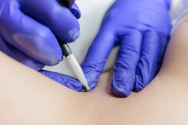 close-up of the procedure of electrolysis where the doctor is a cosmetologist How does a special electric tool and tweezers work