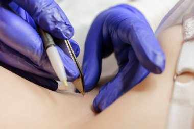 macro photography working doctor electrolysis using an electrode and tweezers permanent hair removal procedure