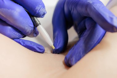 macro photography working doctor electrolysis using an electrode and tweezers permanent hair removal procedure