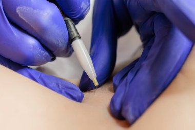 close-up of the tip of the hair electrolysis device where the doctor inserts the needle into the hair follicle