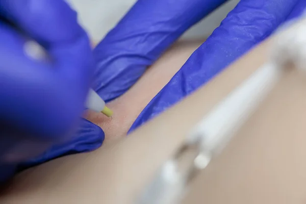 hair follicle removal with electrolysis close-up