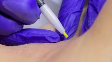 super macro photography procedure for electrolysis of the armpit zone, the doctor penetrates the hair follicle with a thin electrode