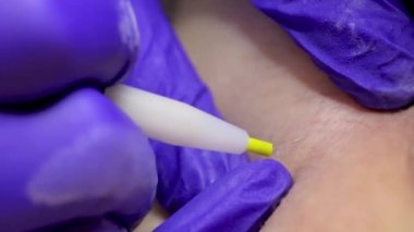 electrolysis procedure, the master pulls out the hair with tweezers after exposure to electricity on the hair follicle