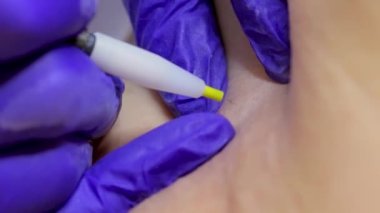 close-up electrolysis procedure, the master penetrates the hair follicle with an electrode