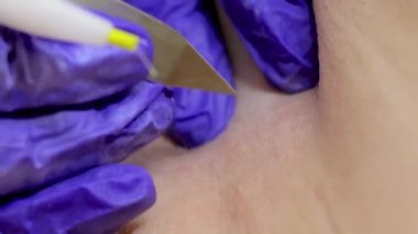 close-up electrolysis procedure, the master penetrates the hair follicle with an electrode