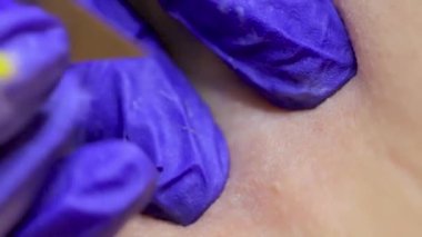 electrolysis procedure, the master pulls out the hair with tweezers after exposure to electricity on the hair follicle