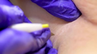 electrolysis procedure, the master pulls out the hair with tweezers after exposure to electricity on the hair follicle