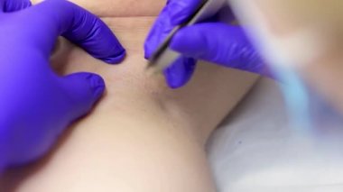 close-up of the hands of an electrolysis doctor who performs a procedure in the armpit area using tweezers and an electrode