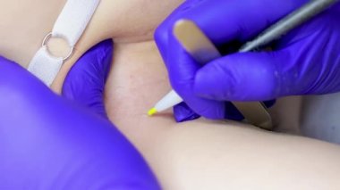 macro photography electrolysis procedure where the master, using tweezers and an electrode, removes hair follicles using electricity