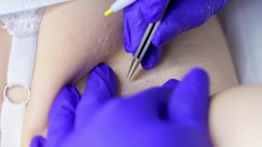 macro photography electrolysis procedure where the master, using tweezers and an electrode, removes hair follicles using electricity