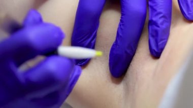 close-up of the electrolysis procedure, the master using a thin electrode penetrates the hair follicle, thereby removing it