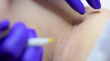 close-up procedure of electrolysis and removal of hair follicles using an electrode and tweezers
