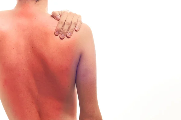 Damage Concept Back Skin Damaged Sun Rays — Stock Photo, Image