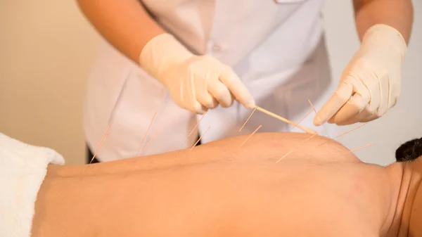 Beautiful Woman Received acupuncture treatment on back by  therapist, chinese medicine treatment, health and healing concept.